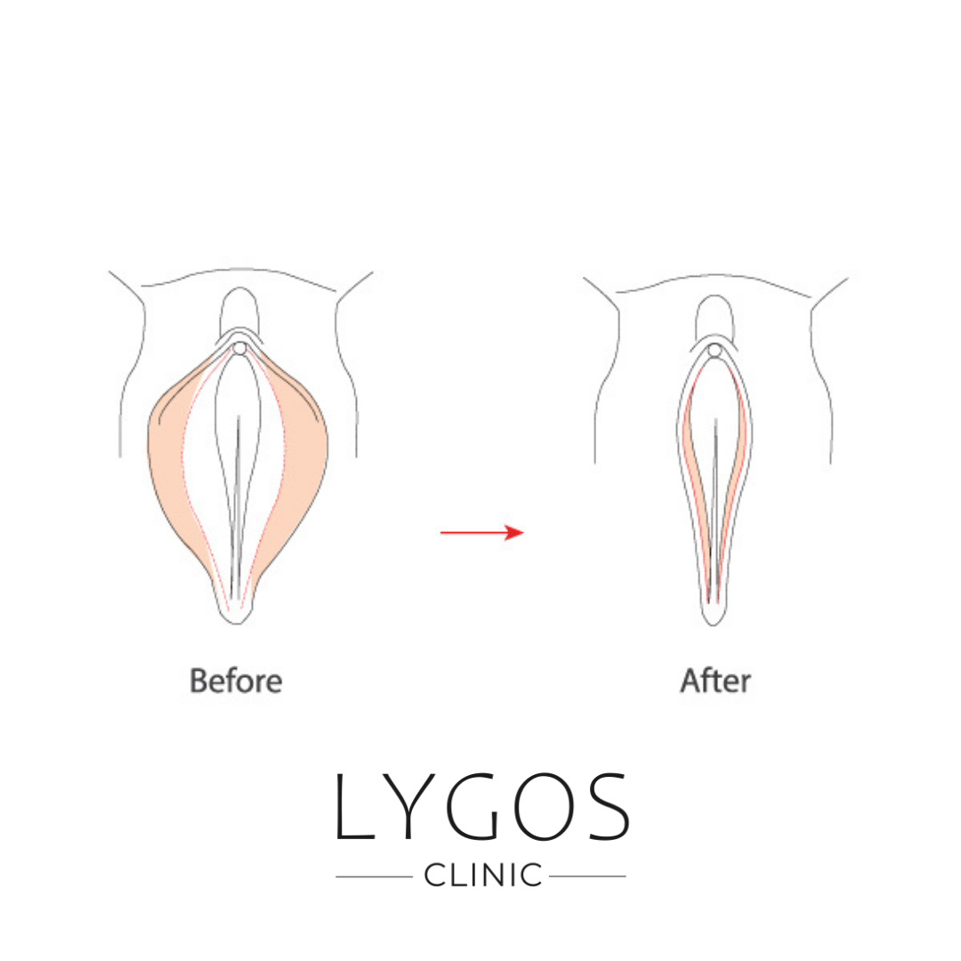 4 Genital Vajina Estetigi Nasil Yapilir 1