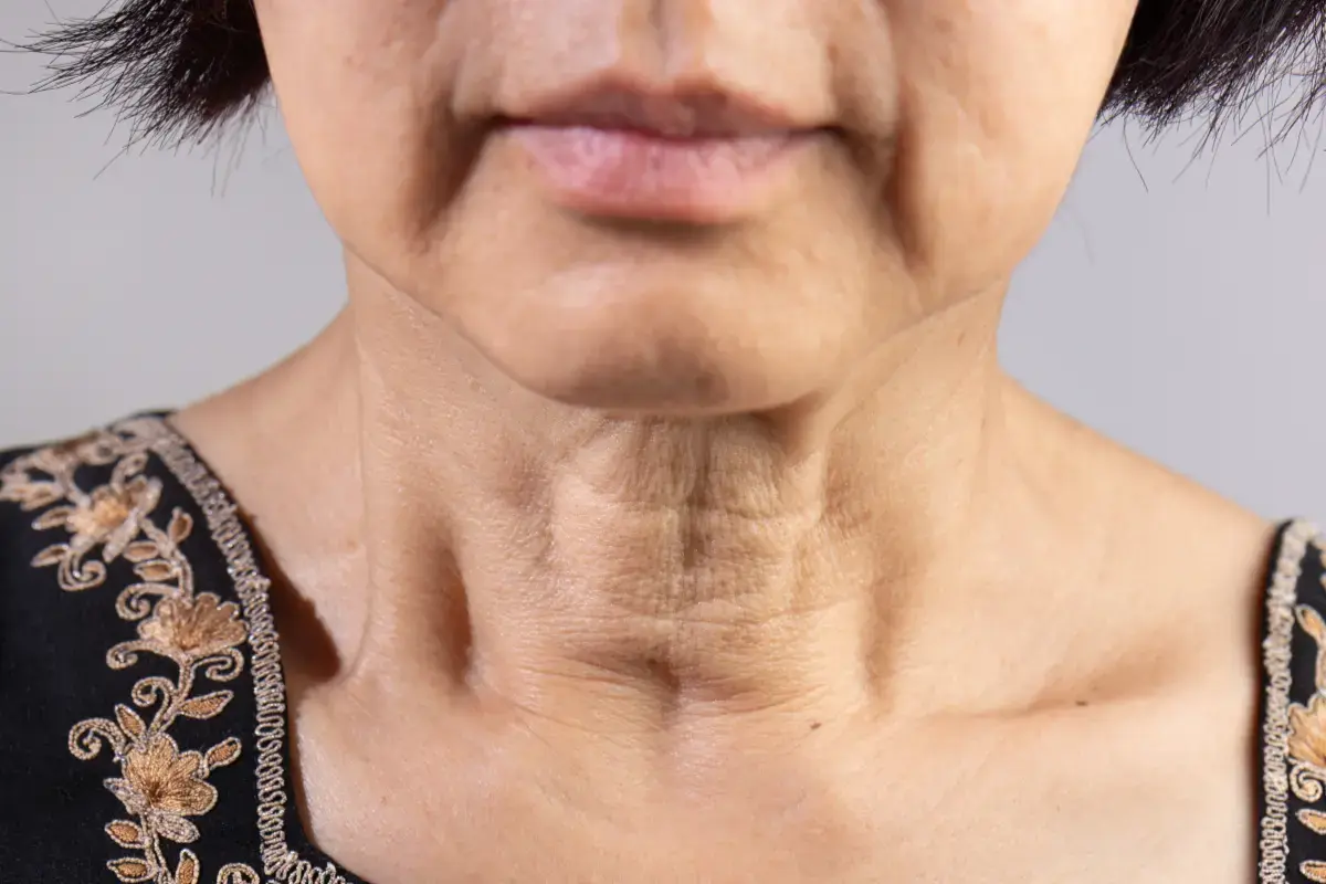 What Helps Neck Wrinkles