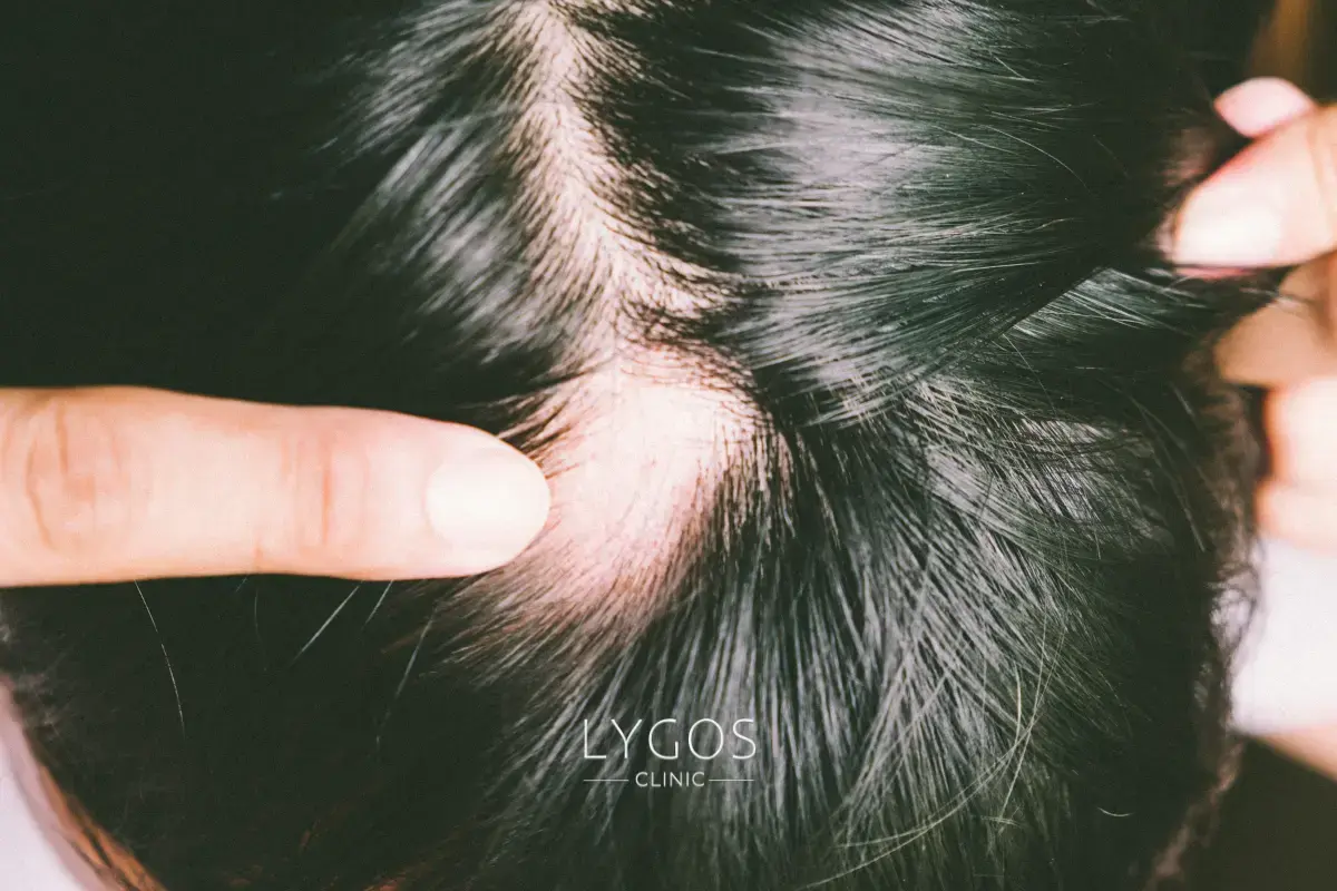 Clascoterone serumu kimler için uygundur