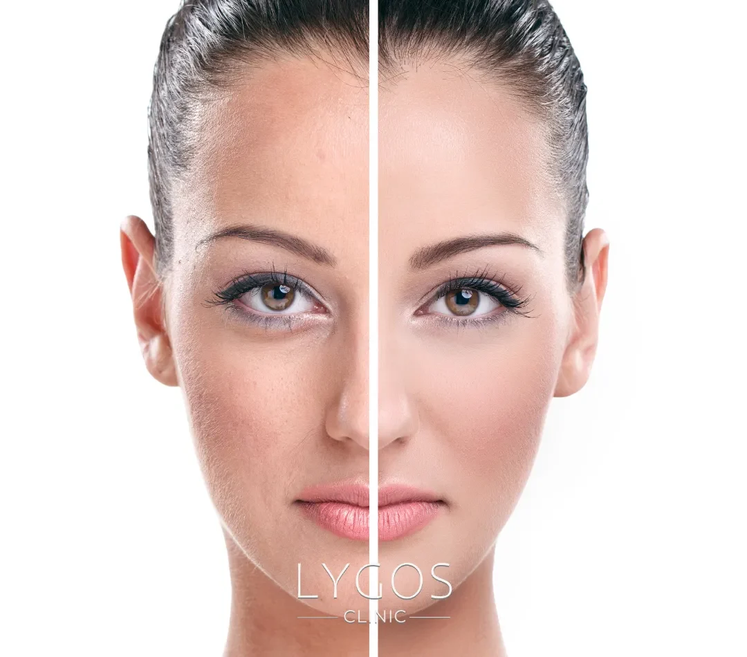 Somon-DNA-Asisi-oncesi-ve-Sonrasi_result somon dna aşısı öncesi ve sonrası